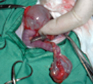 卵巣嚢胞の摘出手術